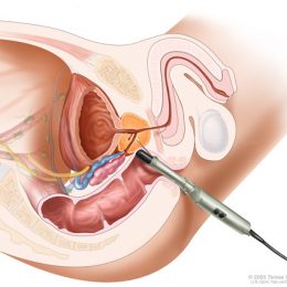 Ultrasonido anorrectal