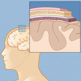 craneofaringioma-meningioma-quiste-rathke