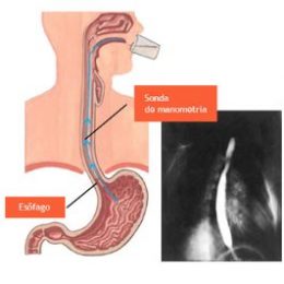 manometria-esofagica